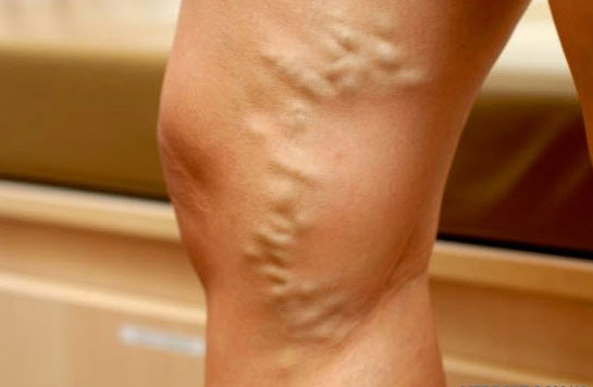 From what ointment Troxevasin: pathology of blood vessels, skin, soft tissues